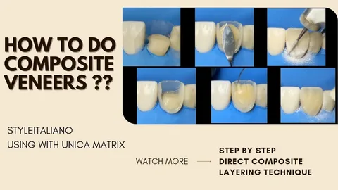 composite veneers near me
